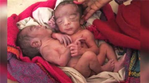 　中新网12月24日电 据外媒报道，印度一名妇女近日产下双胞胎连体婴，这对兄弟共有2个头、4只手、2只脚，家人们对于这对兄弟的模样感到非常惊讶。虽然男婴目前十分健康，但医生认为存活机率并不乐观。